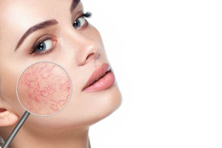 trądzik różowaty