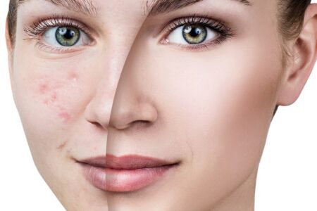 trądzik młodzieńczy